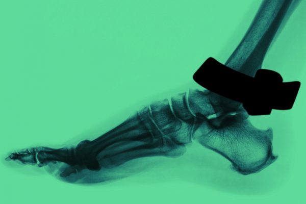 Ankle X-ray showing calcaneus heel bone securing GPS ankle monitor - bone structure prevents device removal
